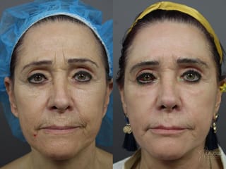 Before and after SP Dynamis case 36156 - Angle 1