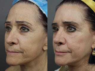 Before and after SP Dynamis case 36156 - Angle 2