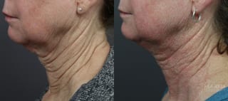 Before and after Laser Coring (Poke A Dot Lift®) case 36157 - Angle 1