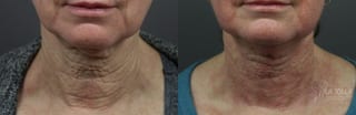 Before and after Laser Coring (Poke A Dot Lift®) case 36157 - Angle 2