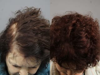 Before and after Laser Hair Growth case 36158 - Angle 1