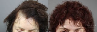 Before and after Laser Hair Growth case 36158 - Angle 2