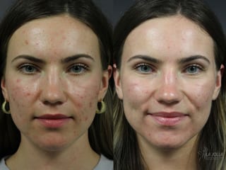 Before and after Acne: Laser Treatment case 36160 - Angle 1