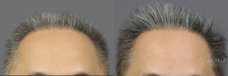 Before and after PRP (Platelet-Rich Plasma) case 36162 - Angle 2