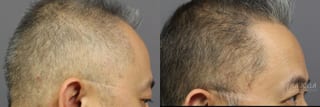 Before and after PRP (Platelet-Rich Plasma) case 36162 - Angle 3