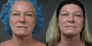 Before and after Ablative Laser Treatment case 36163 - Angle 1