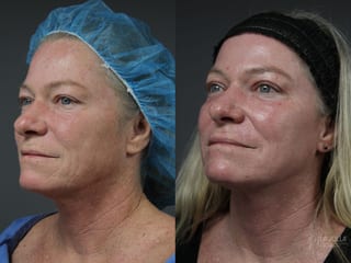 Before and after Ablative Laser Treatment case 36163 - Angle 2