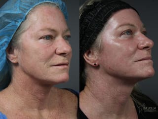 Before and after Ablative Laser Treatment case 36163 - Angle 3