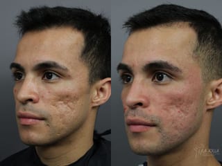 Before and after Acne Scars: Subcision case 36164 - Angle 1