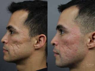 Before and after Acne Scars: Subcision case 36164 - Angle 4