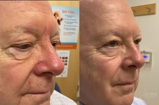 Before and after VBeam case 36169 - Angle 1