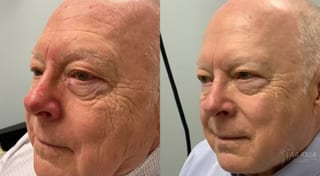 Before and after VBeam case 36169 - Angle 2