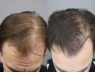 Before and after Laser Hair Growth case 36172 - Angle 2