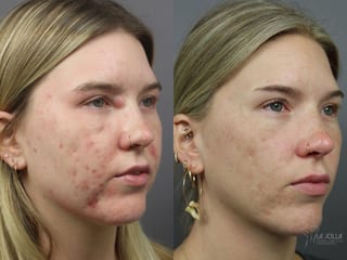 Before and after Acne: Laser Treatment case 36179 - Angle 1