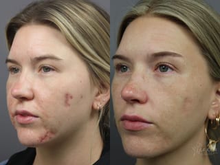 Before and after Acne: Laser Treatment case 36179 - Angle 2