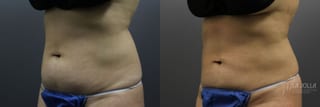 Before and after CoolSculpting® case 36180 - Angle 1
