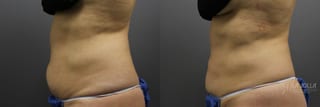 Before and after CoolSculpting® case 36180 - Angle 2