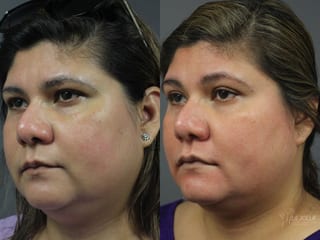 Before and after Chemical Peel case 36181 - Angle 1