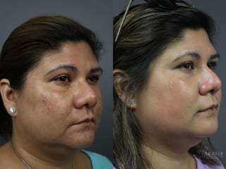Before and after Chemical Peel case 36181 - Angle 2