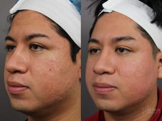 Before and after Acne Scars: Subcision case 36182 - Angle 1