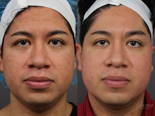 Before and after Acne Scars: Subcision case 36182 - Angle 2