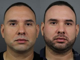 Before and after Fraxel® case 36183 - Angle 1