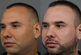 Before and after Fraxel® case 36183 - Angle 2