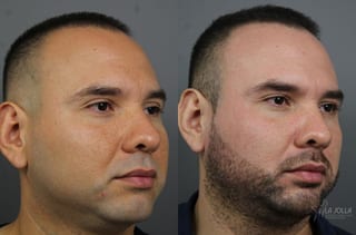 Before and after Fraxel® case 36183 - Angle 3
