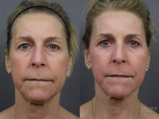 Before and after Fractional CO2 case 36184 - Angle 1