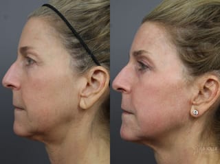Before and after Fractional CO2 case 36184 - Angle 2