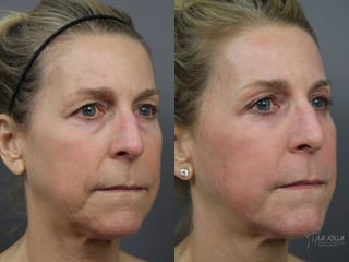 Before and after Fractional CO2 case 36184 - Angle 3