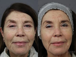 Before and after Fraxel® case 36197 - Angle 1