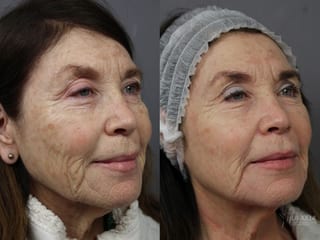 Before and after Fraxel® case 36197 - Angle 2