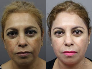 Before and after Chemical Peel case 36200 - Angle 1