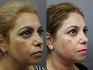 Before and after Chemical Peel case 36200 - Angle 2