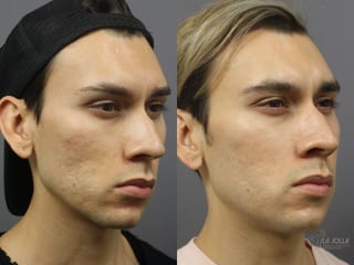 Before and after Acne: Laser Treatment case 36201 - Angle 1