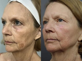 Before and after SP Dynamis case 36202 - Angle 1