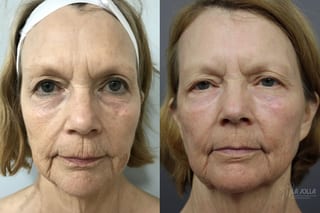 Before and after SP Dynamis case 36202 - Angle 2