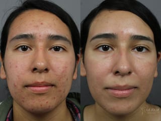 Before and after Acne: Laser Treatment case 36203 - Angle 1