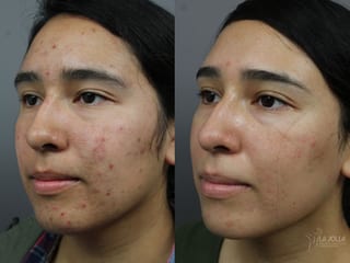Before and after Acne: Laser Treatment case 36203 - Angle 2