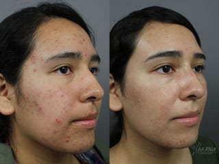 Before and after Acne: Laser Treatment case 36203 - Angle 3