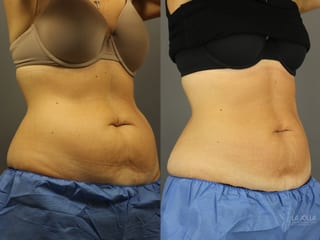 Before and after CoolSculpting® case 36204 - Angle 1