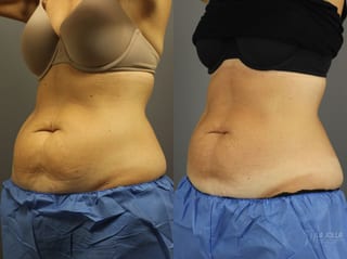 Before and after CoolSculpting® case 36204 - Angle 2