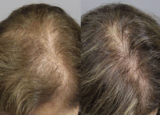 Before and after Laser Hair Growth case 36208 - Angle 2