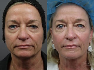 Before and after Sculptra® case 36215 - Angle 1