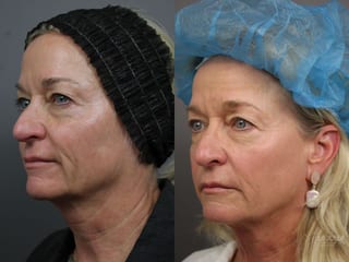 Before and after Sculptra® case 36215 - Angle 2