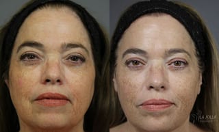 Before and after Sculptra® case 36220 - Angle 1