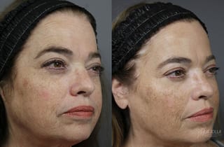 Before and after Sculptra® case 36220 - Angle 3