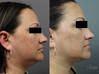 Before and after Kybella case 36221 - Angle 1
