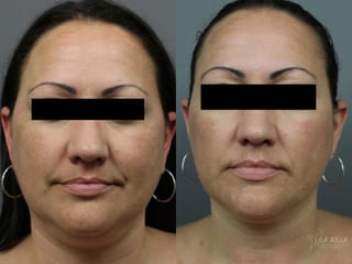 Before and after Kybella case 36221 - Angle 2